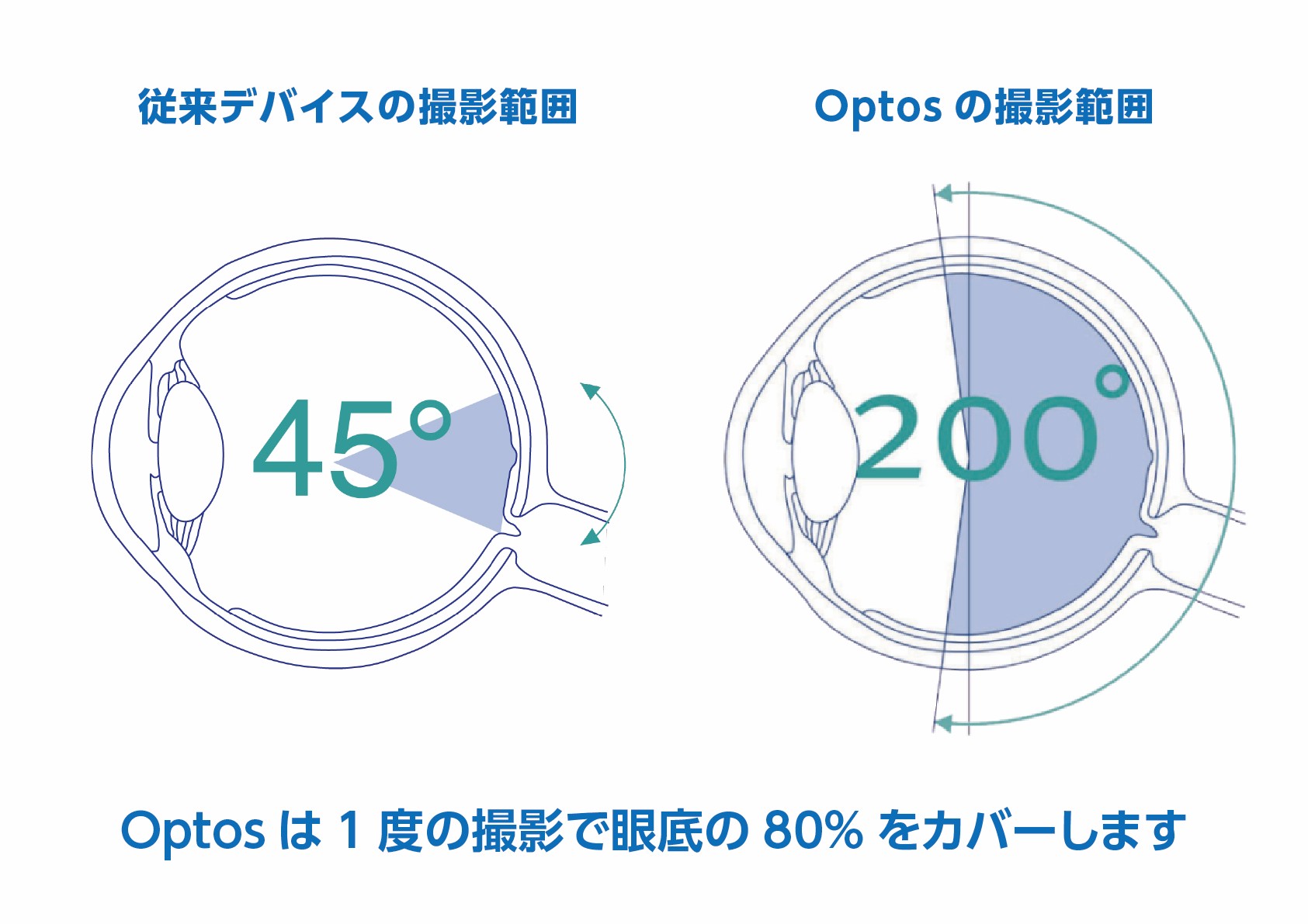Optos Daytona Nextは1度の撮影で眼底の80％をカバーします
