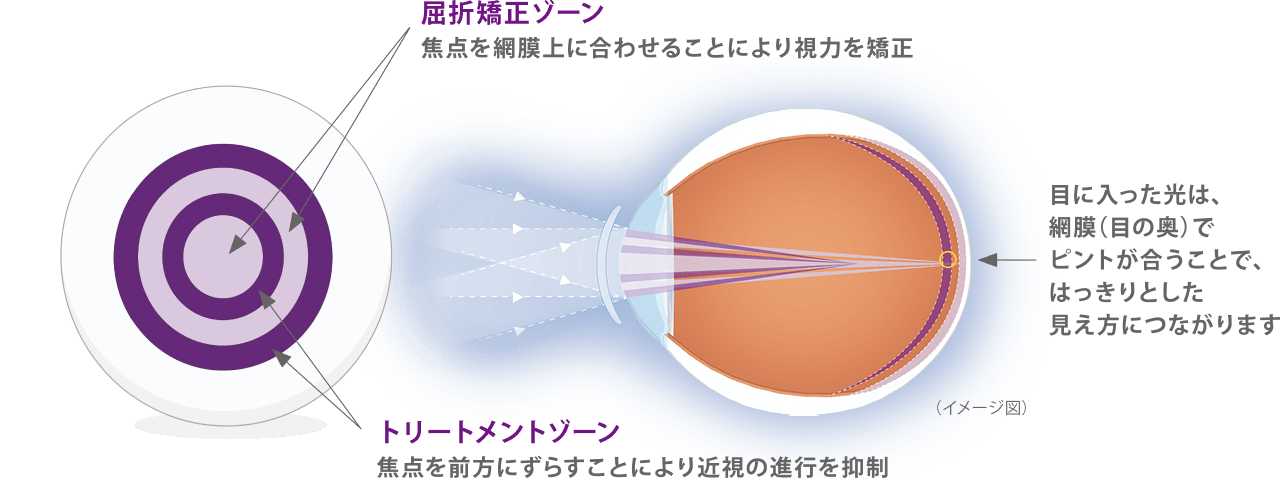 近視の進行を抑える設計（デュアルフォーカス構造）
